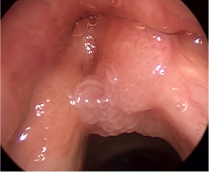 respiratory papillomatosis cure papilloma squamoso della lingua